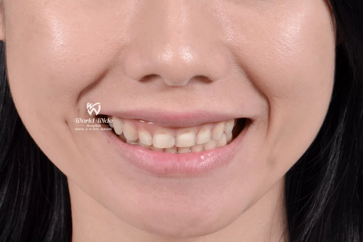 KHẮC PHỤC TÌNH TRẠNG RĂNG NGẮN, MÒN VẸT VÀ CƯỜI LỘ NƯỚU TẠI Kubet RHM WORLDWIDE DSC_8689-min