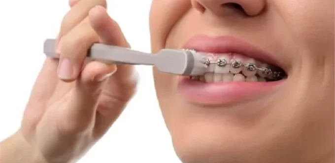 Chăm sóc sau khi răng niềng răng niềng