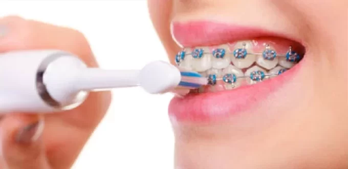 Chăm sóc sau khi răng niềng răng niềng