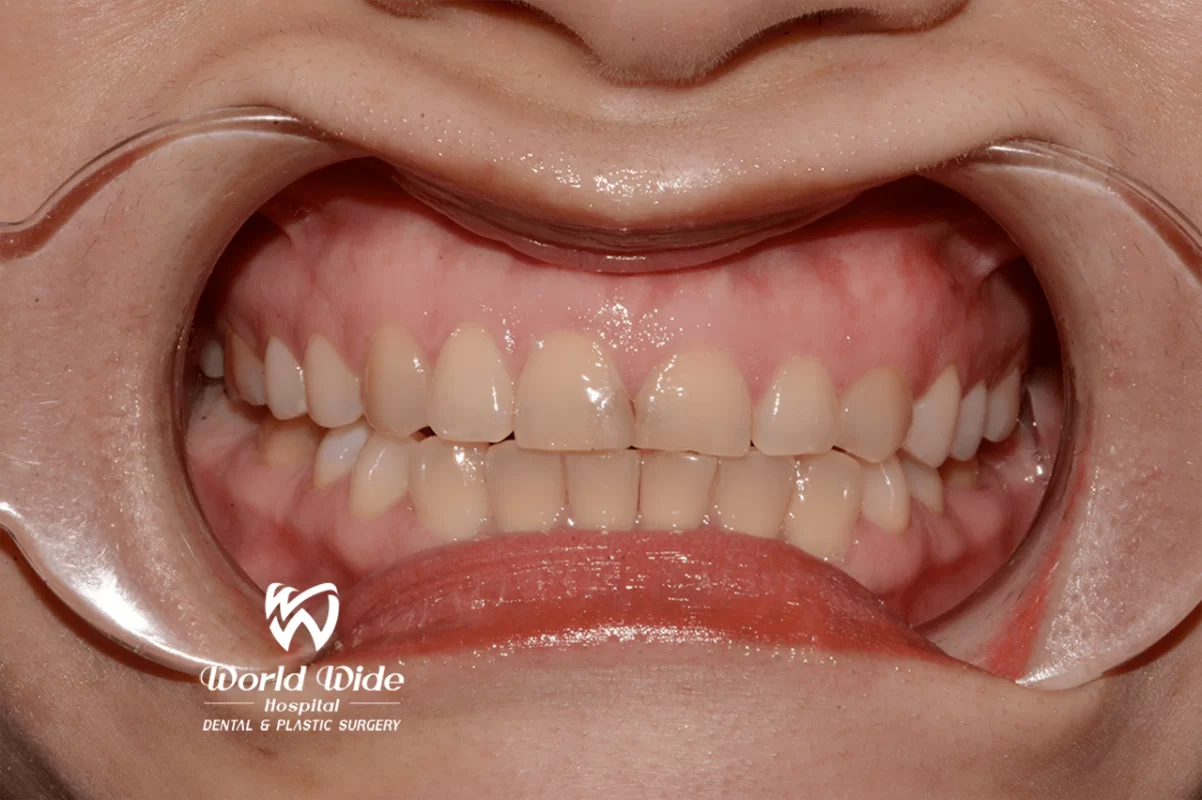 THAY CÁC MIẾNG TRÁM CŨ ĐỔI MÀU BẰNG DÁN SỨ VENEER SIÊU MỎNG TẠI Kubet WORLDWIDE DSC_1017_logo-min