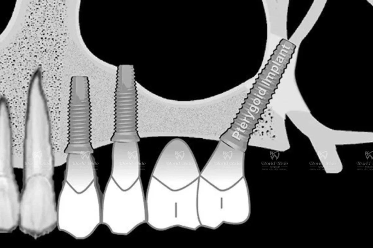 6 BEST BENEFITS OF PTERYGOID IMPLANT Implant chân bướm hình b3.3