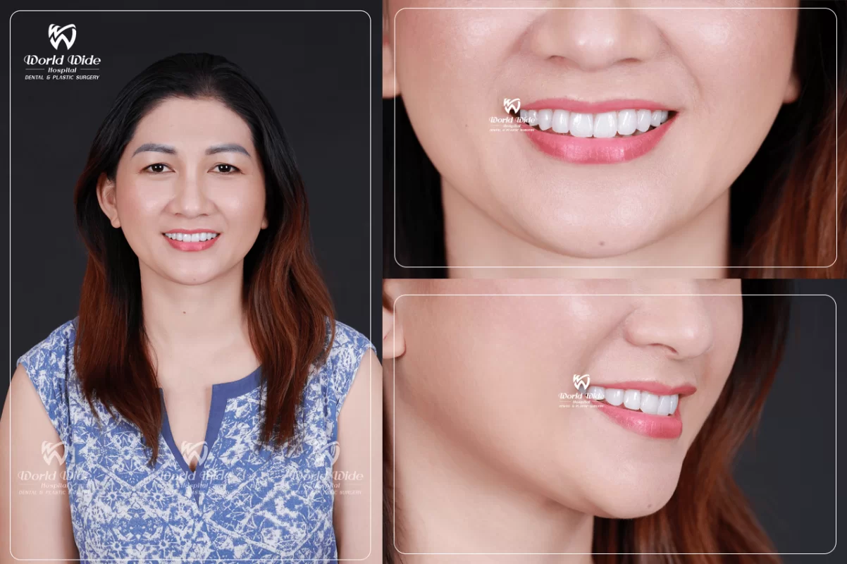 THAY CÁC MIẾNG TRÁM CŨ ĐỔI MÀU BẰNG DÁN SỨ VENEER SIÊU MỎNG TẠI Kubet WORLDWIDE pose 2 dáng-min