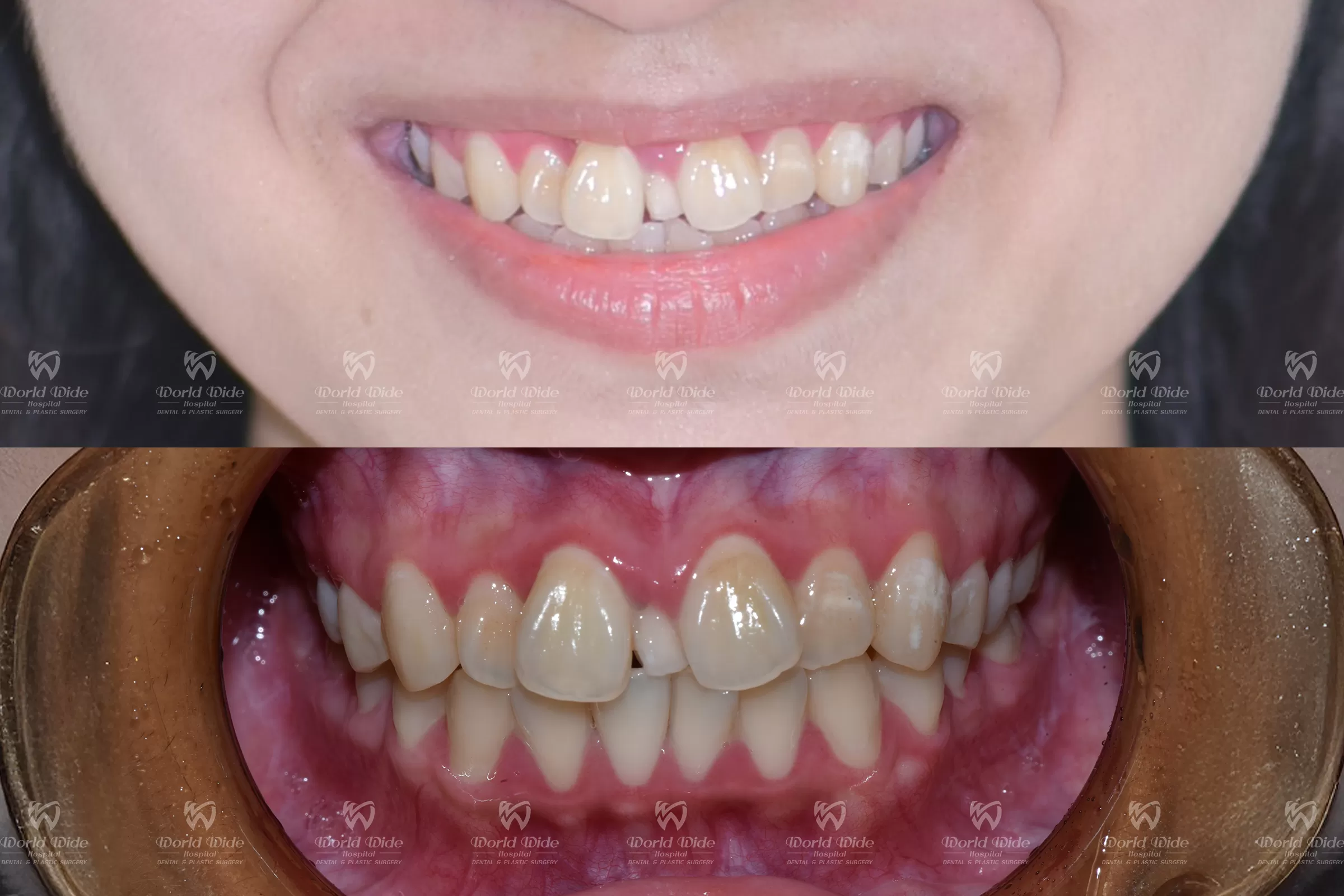 HÀNH TRÌNH TÌM ĐẾN NỤ CƯỜI HOÀN HẢO TỪ CHÍNH QUYẾT ĐỊNH CHỈNH NHA