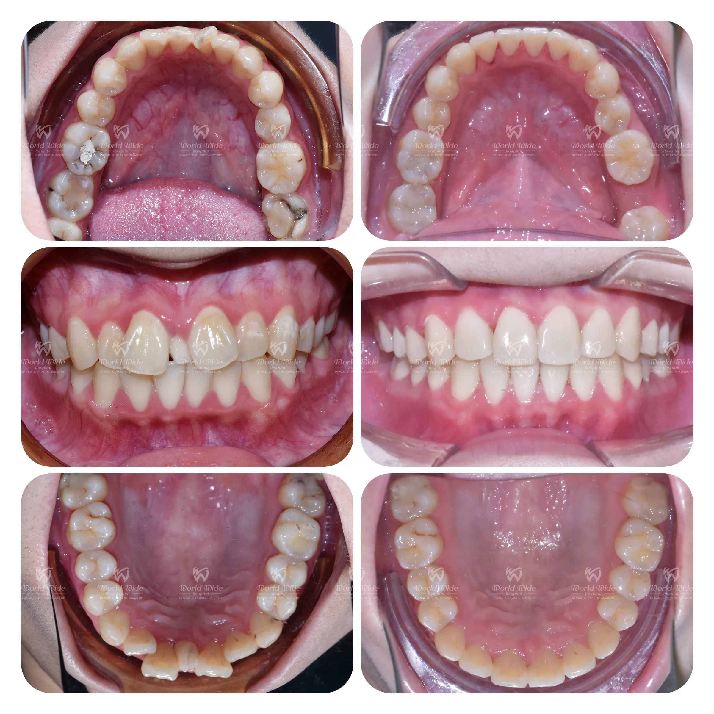 HÀNH TRÌNH TÌM ĐẾN NỤ CƯỜI HOÀN HẢO TỪ CHÍNH QUYẾT ĐỊNH CHỈNH NHA