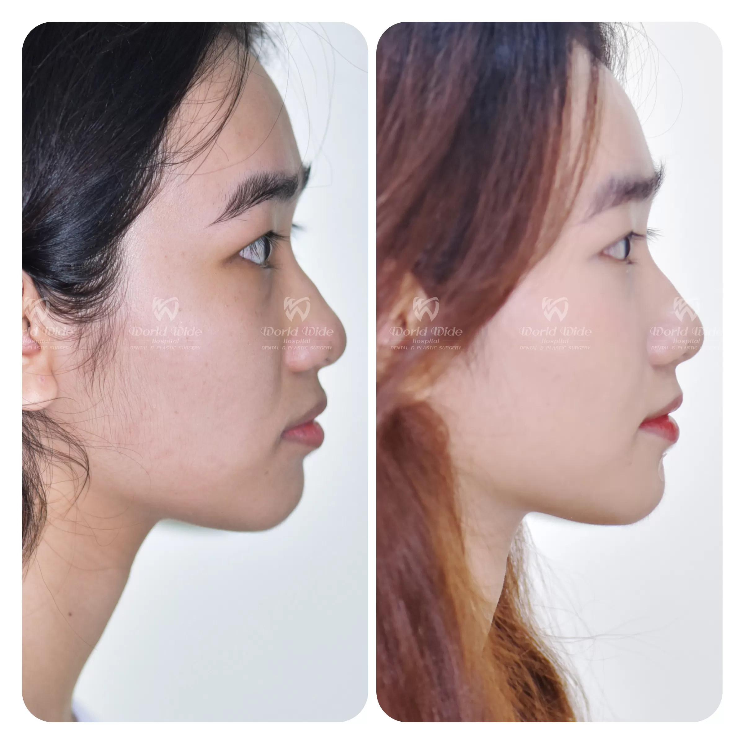 HÀNH TRÌNH TÌM ĐẾN NỤ CƯỜI HOÀN HẢO TỪ CHÍNH QUYẾT ĐỊNH CHỈNH NHA