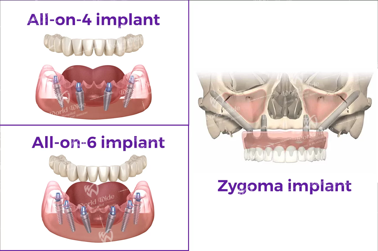 Số hóa trong điều trị Implant tại Kubet RHM Worldwide