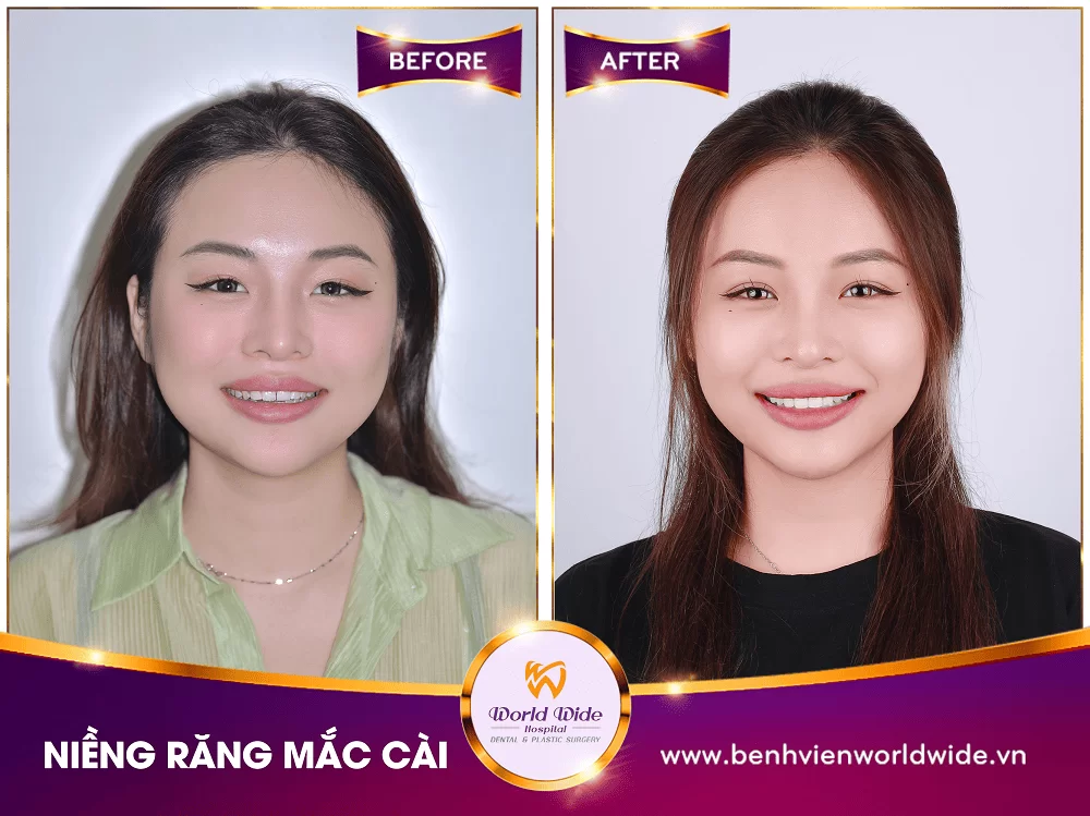 Gallery nieng rang mac cai