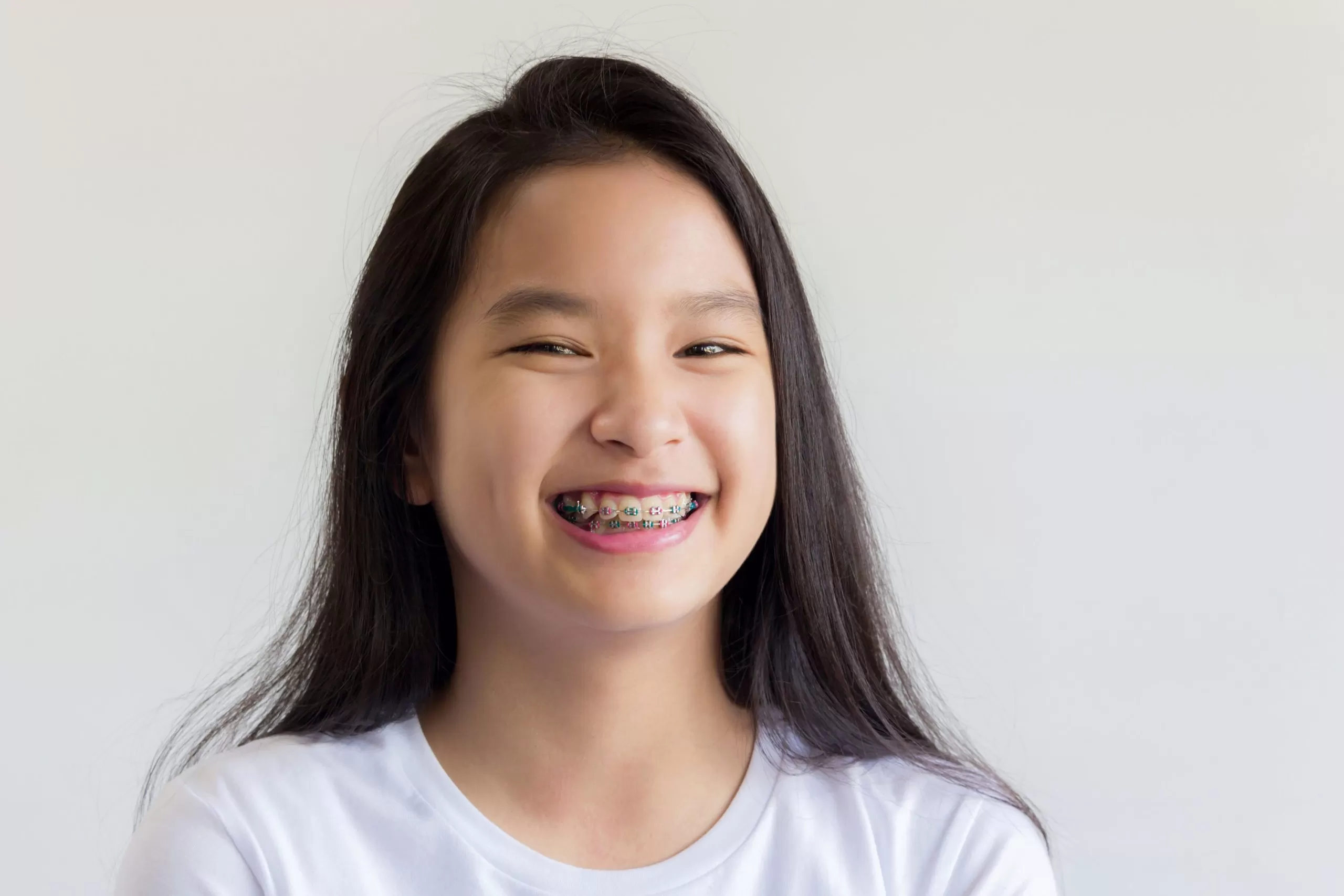 Độ tuổi lý tưởng để niềng răng: Trẻ em, thanh thiếu niên hay người lớn?