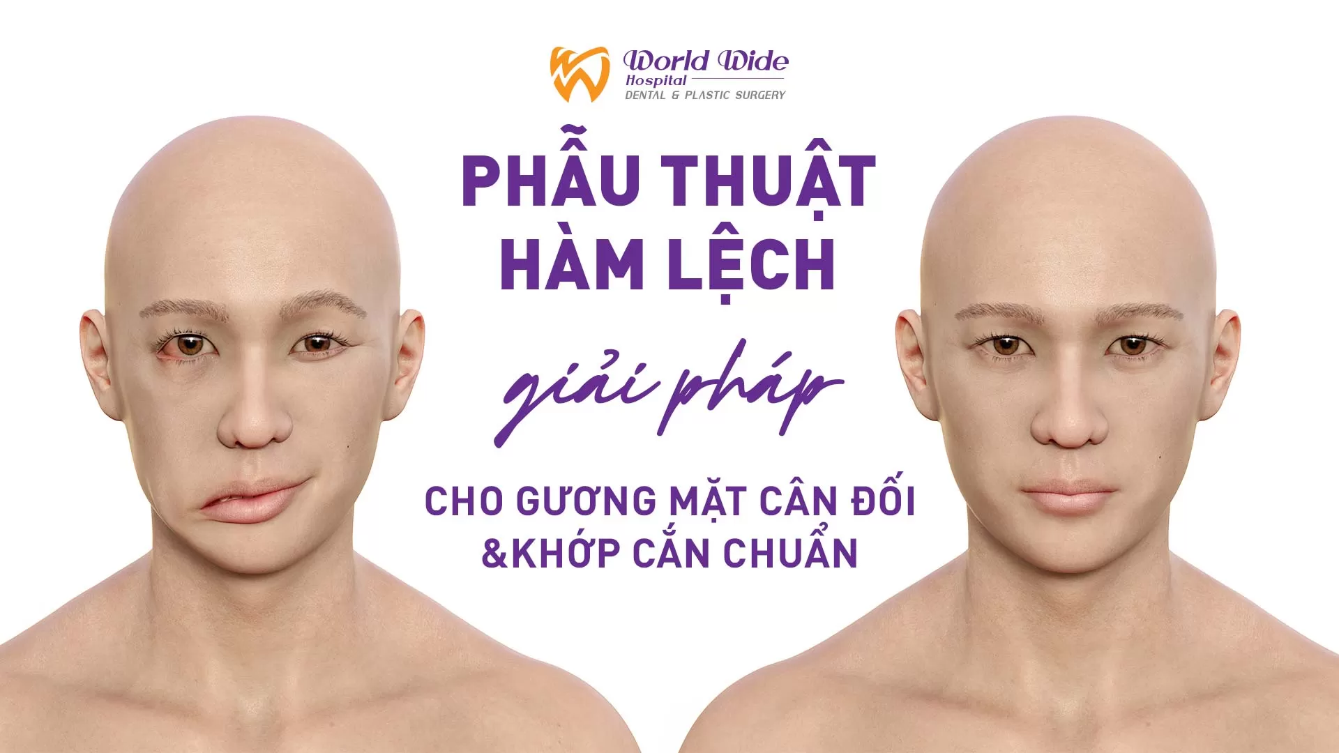 PHẪU THUẬT HÀM LỆCH: GIẢI PHÁP CHO GƯƠNG MẶT CÂN ĐỐI VÀ KHỚP CẮN CHUẨN