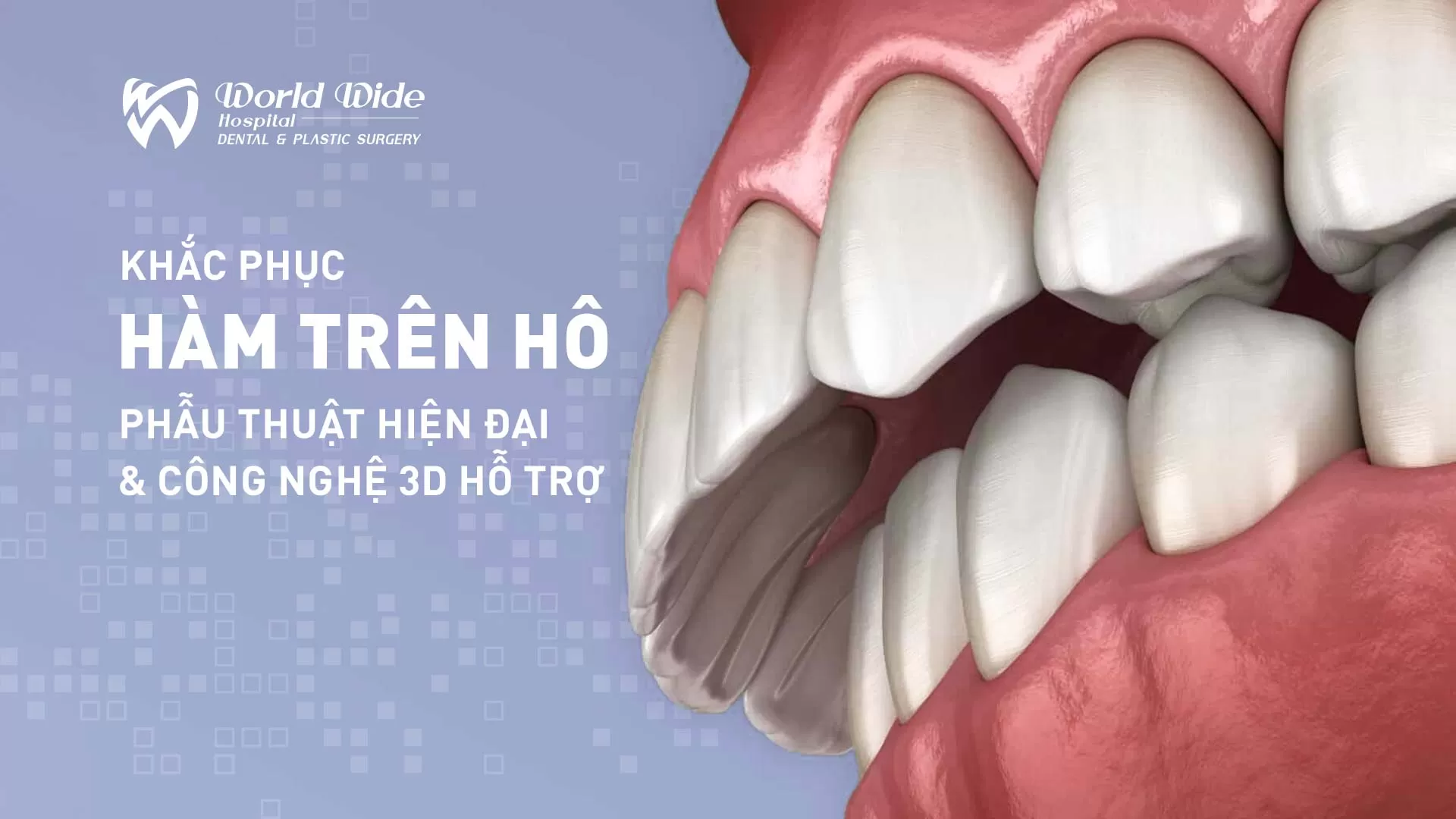 Khắc phục hàm trên hô: Phẫu thuật hiện đại và công nghệ 3D hỗ trợ