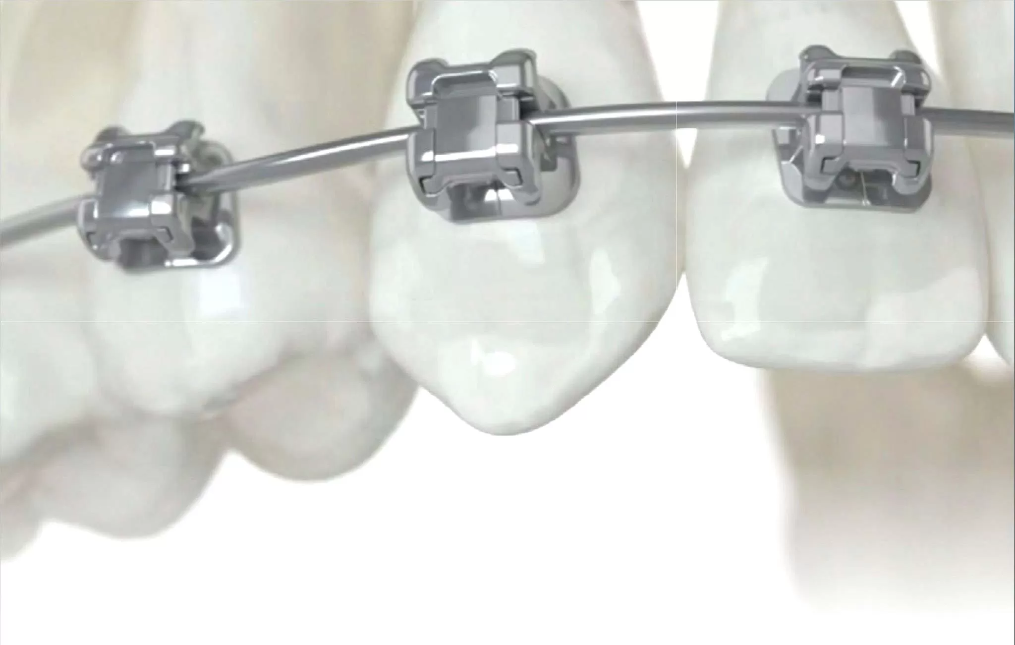 NIỀNG RĂNG TỰ KHÓA CÓ THỰC SỰ NHANH HƠN? PHÂN TÍCH TỪ GÓC NHÌN BÁC SĨ
