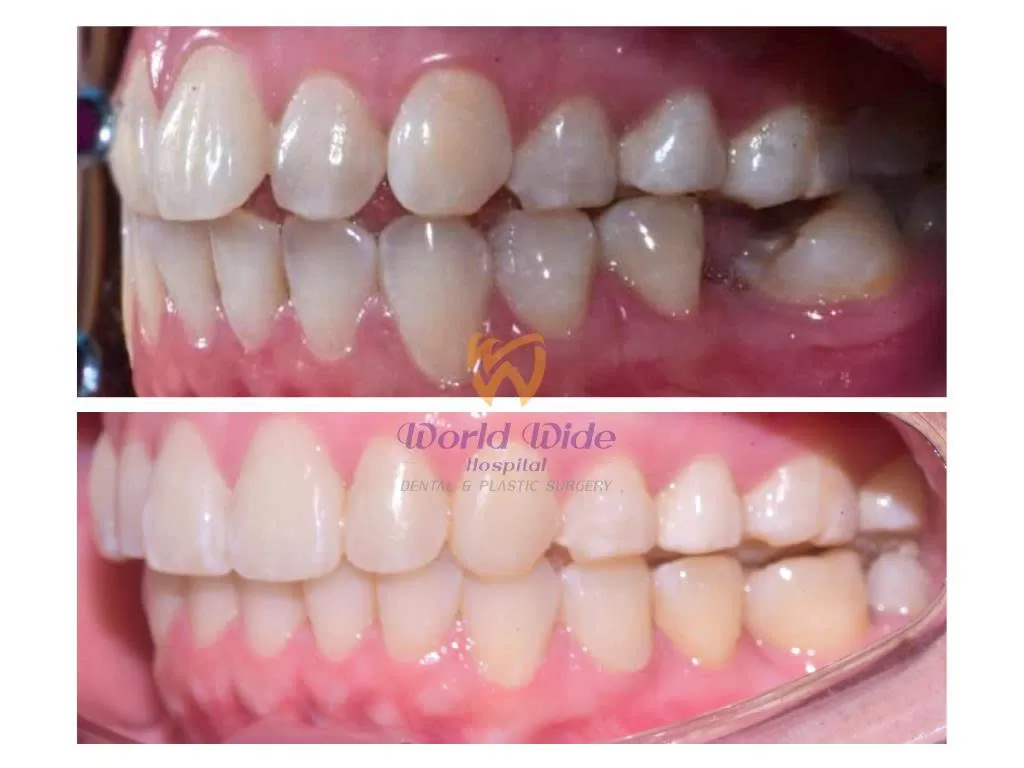 NIỀNG RĂNG CÓ THAY THẾ ĐƯỢC PHẪU THUẬT HÀM KHÔNG?