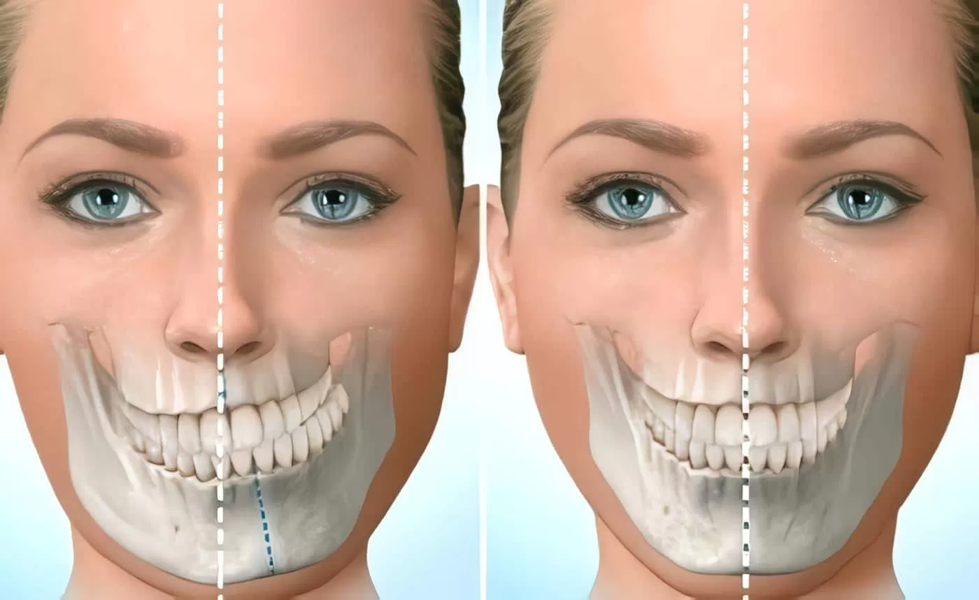 PHẪU THUẬT HÀM LỆCH: GIẢI PHÁP CHO GƯƠNG MẶT CÂN ĐỐI VÀ KHỚP CẮN CHUẨN