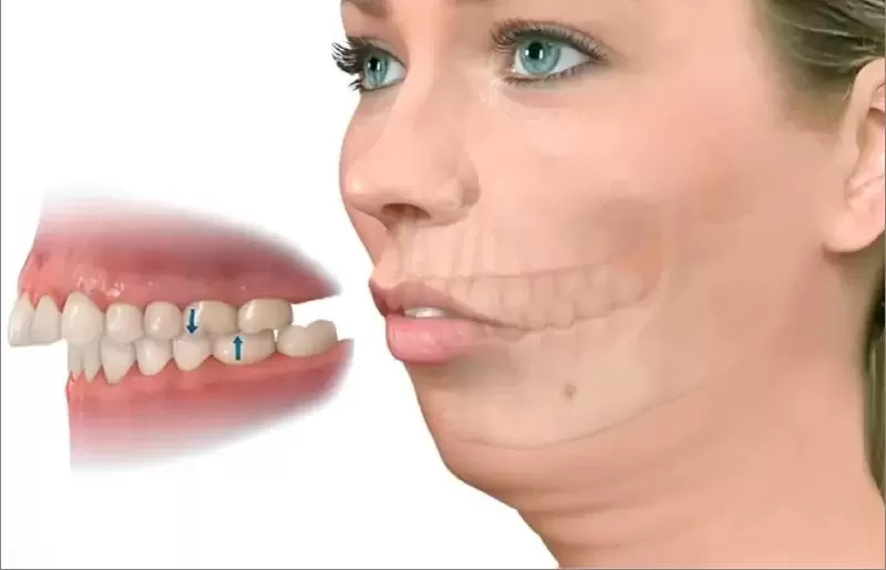 PHẪU THUẬT HÀM LỆCH: GIẢI PHÁP CHO GƯƠNG MẶT CÂN ĐỐI VÀ KHỚP CẮN CHUẨN