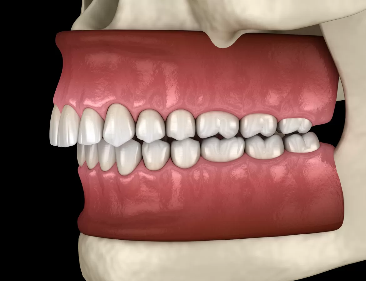 PHẪU THUẬT HÀM LỆCH: GIẢI PHÁP CHO GƯƠNG MẶT CÂN ĐỐI VÀ KHỚP CẮN CHUẨN