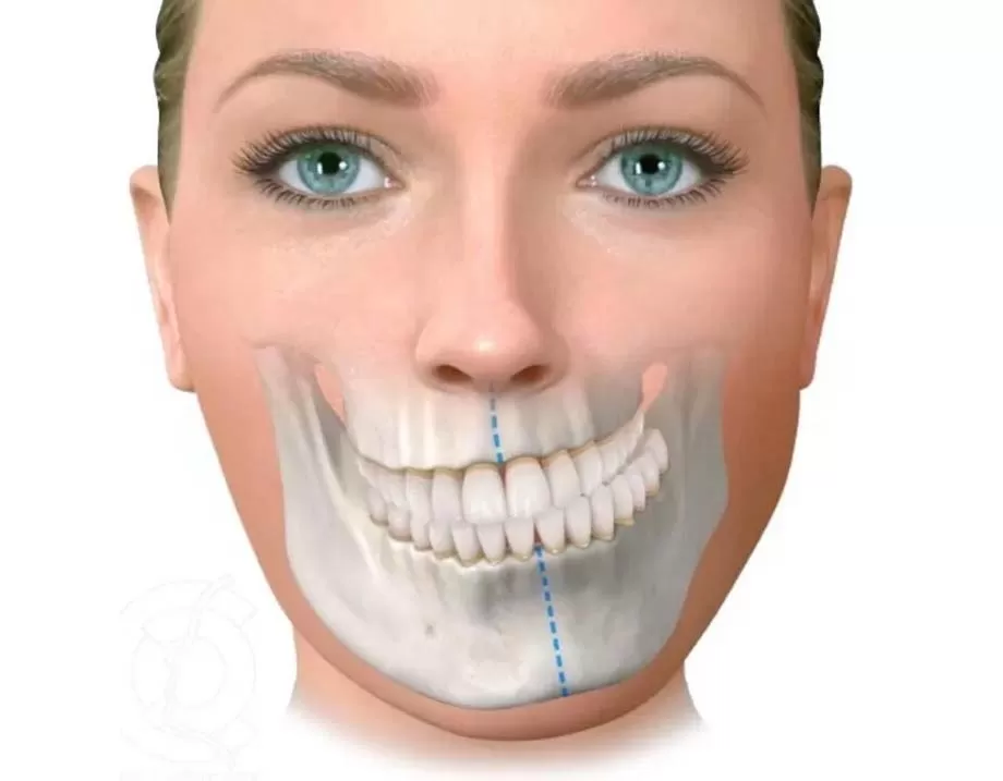 MẶT LỆCH, HÀM LỆCH CÓ PHẪU THUẬT ĐƯỢC KHÔNG?