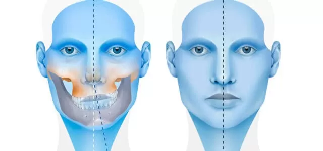 MẶT LỆCH, HÀM LỆCH CÓ PHẪU THUẬT ĐƯỢC KHÔNG?