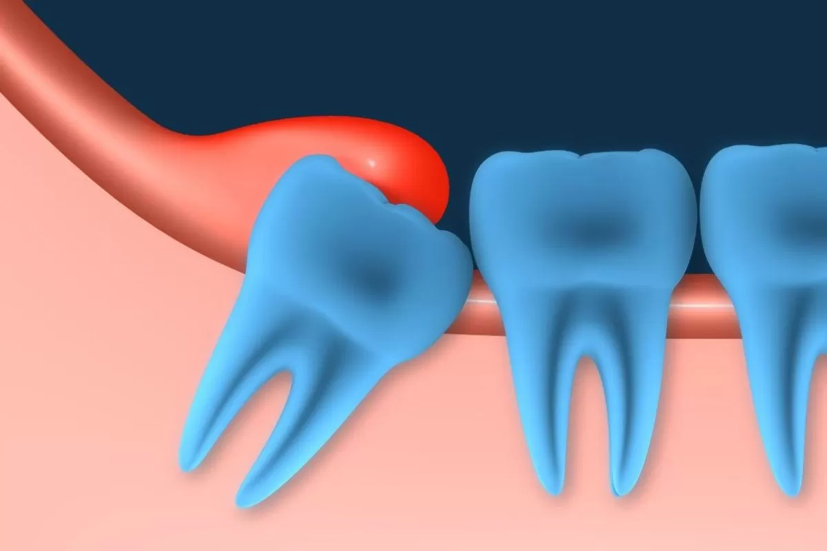RĂNG KHÔN GẦN DÂY THẦN KINH – CÓ NÊN NHỔ KHÔNG? GIẢI ĐÁP TỪ GÓC NHÌN CHUYÊN MÔN