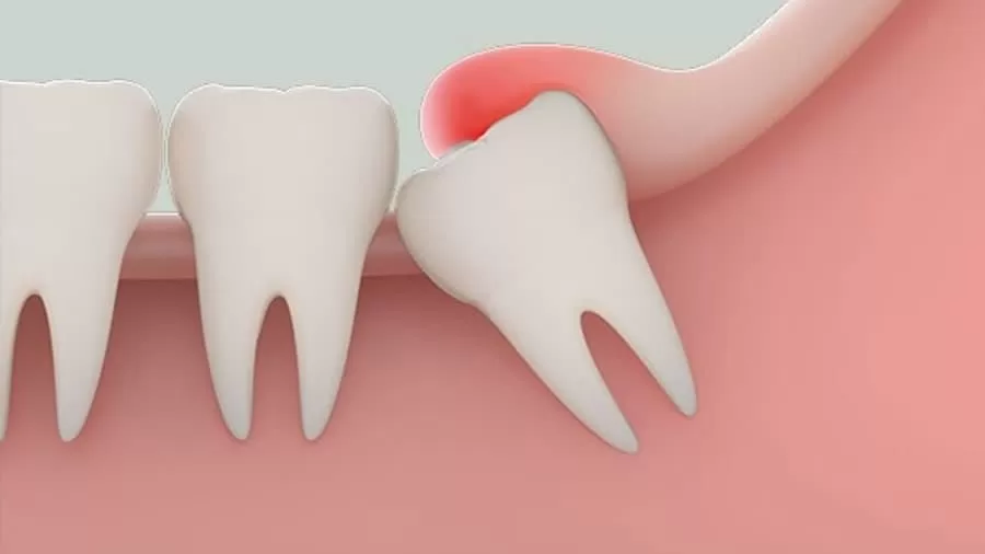 NHỔ RĂNG KHÔN BẰNG MÁY PIEZOTOME – GIẢI PHÁP ÍT ĐAU, ÍT SƯNG TẠI Kubet RHM WORLDWIDE