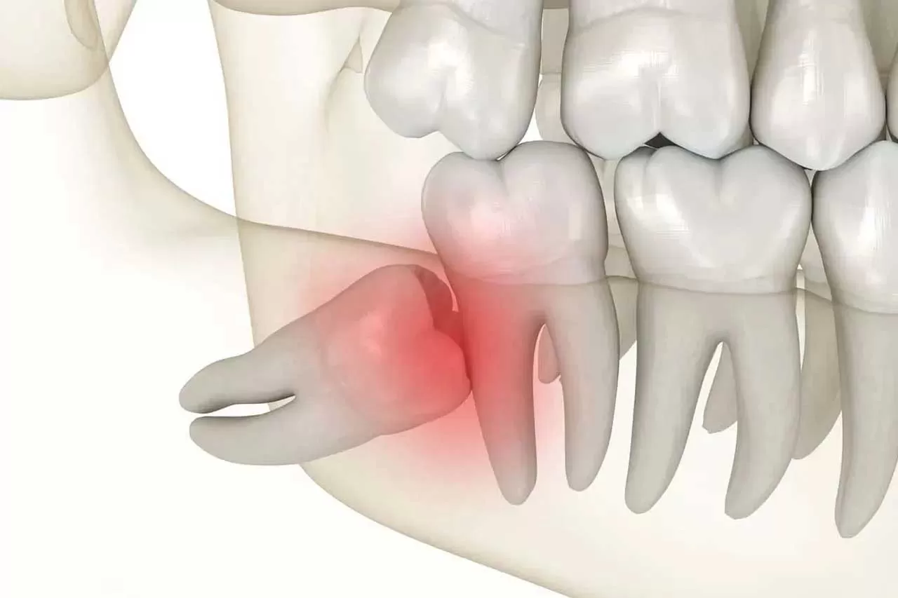RĂNG KHÔN GẦN DÂY THẦN KINH – CÓ NÊN NHỔ KHÔNG? GIẢI ĐÁP TỪ GÓC NHÌN CHUYÊN MÔN
