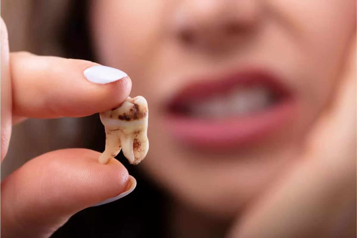 RĂNG KHÔN GẦN DÂY THẦN KINH – CÓ NÊN NHỔ KHÔNG? GIẢI ĐÁP TỪ GÓC NHÌN CHUYÊN MÔN