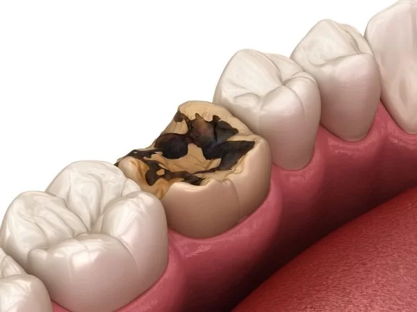 Vì sao trẻ em và người lớn đều nên trám răng sớm khi phát hiện sâu?