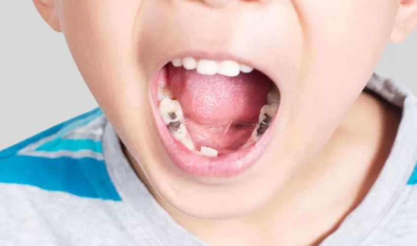 Vì sao trẻ em và người lớn đều nên trám răng sớm khi phát hiện sâu?
